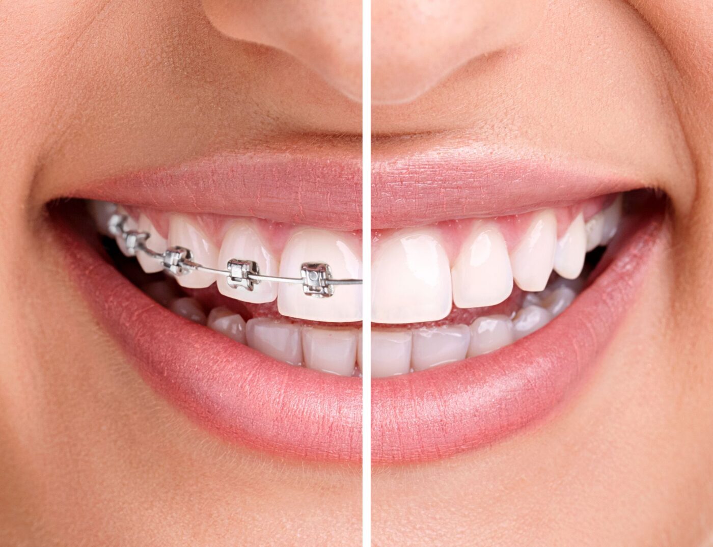 Smiling mouth with braces on half of the upper teeth
