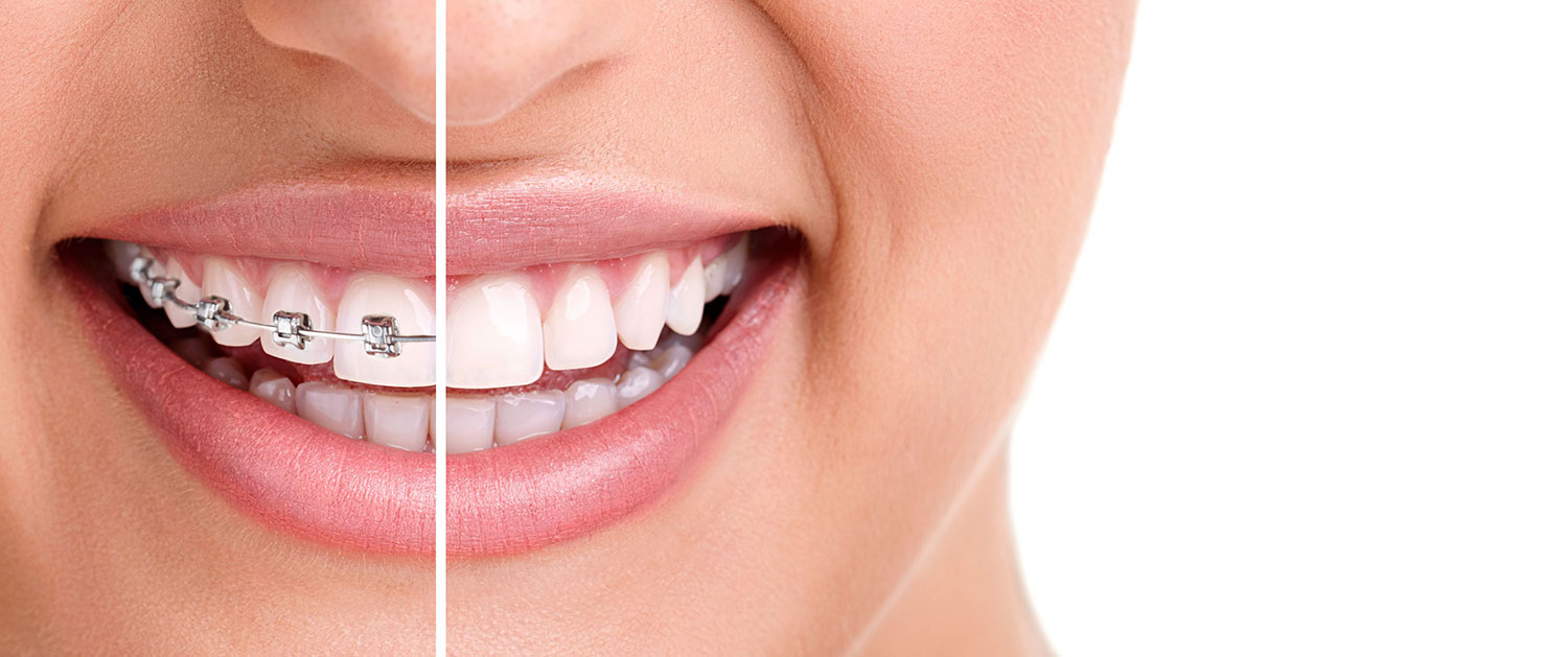 Braces vs invisalign smiling woman teeth
