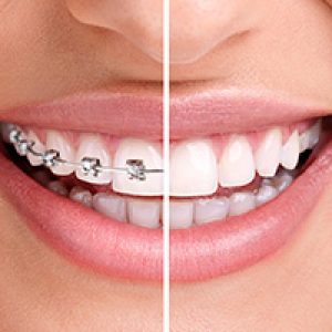 Orthodontics before and after
