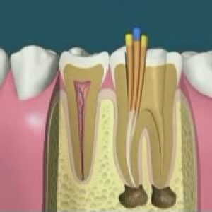 Root Canal diagram