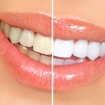 teeth whitening options