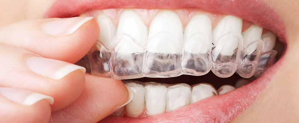 teeth-whitening-tray