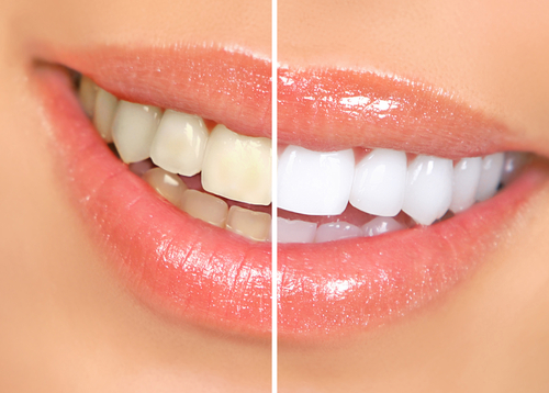 Teeth whitening options
